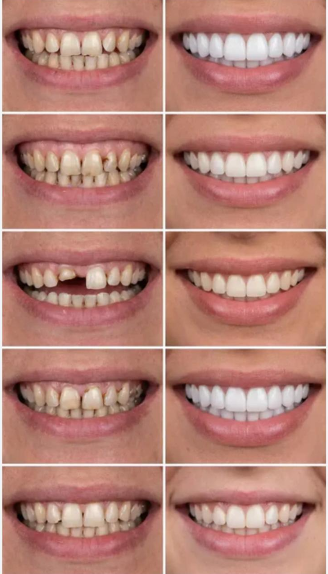 Vorher-Nachher Vergleich Snap-On Veneers
